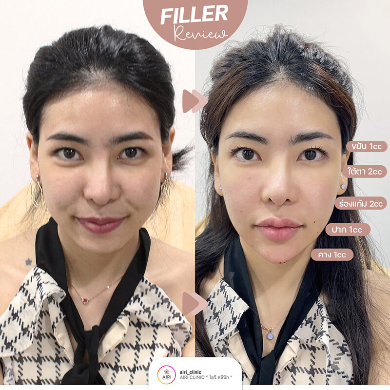 รีวิวฉีดฟิลเลอร์ ฉีดฟิลเลอร์ปาก ฉีดฟิลเลอร์ใต้ตา ฉีดฟิลเลอร์ร่องแก้ม ฉีดฟิลเลอร์คาง ฉีดฟิลเลอร์ขมับ