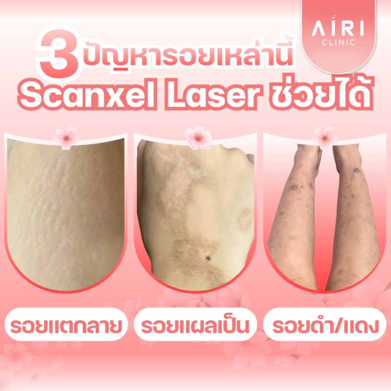 3 ปัญหารอยเหล่านี้ Scanxel Laser ช่วยได้จ้า