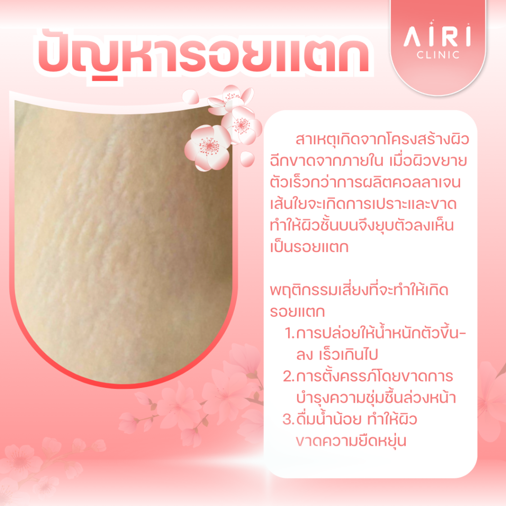 Scanxel Laser Airi Clinic