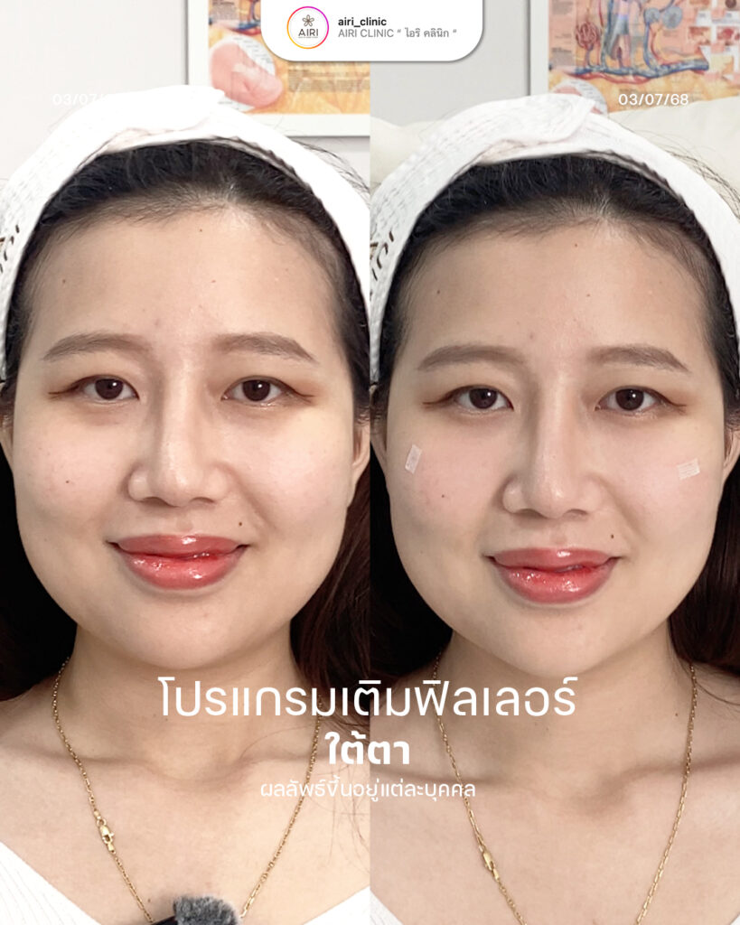 ฟิลเลอร์ใต้ตา