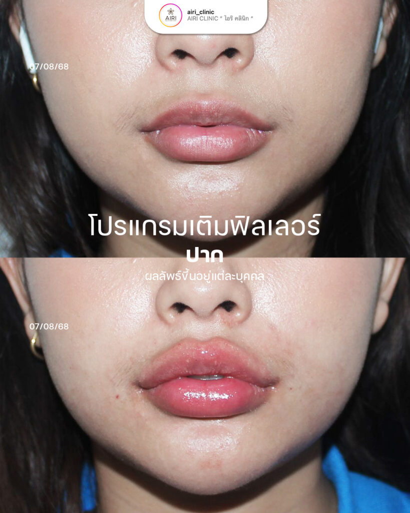 ฟิลเลอร์ปากลูกค้า01