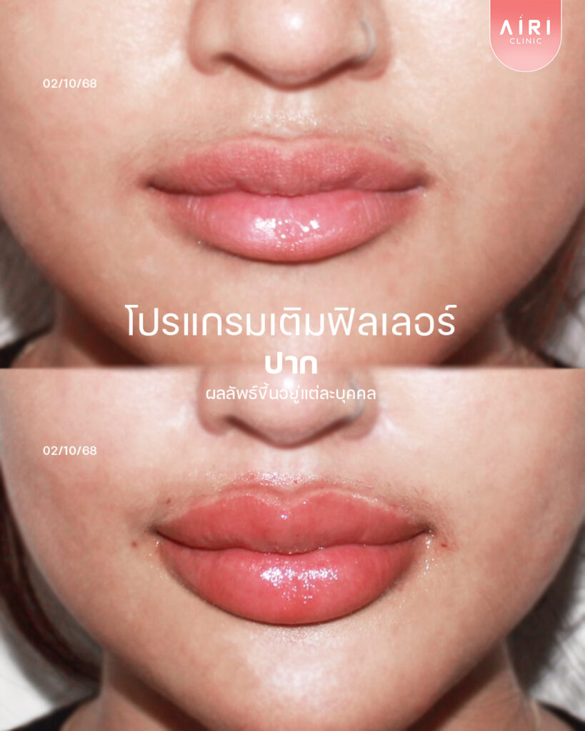 รีวิวฟิลเลอร์ปาก2 