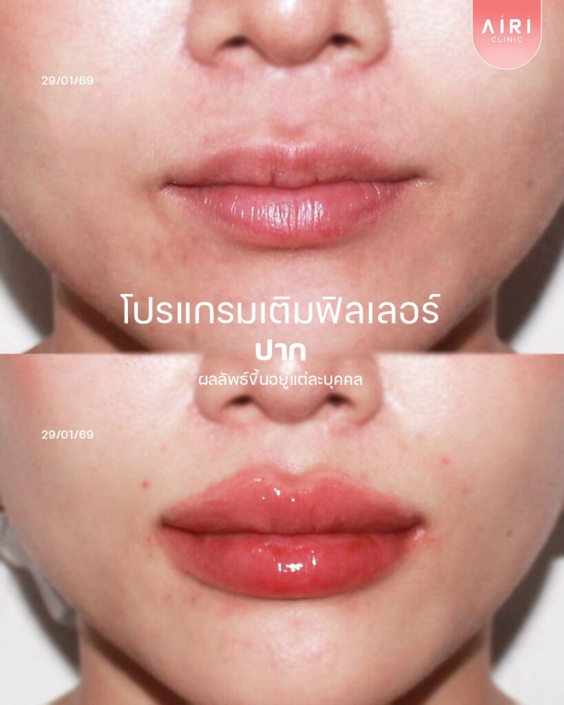 ปากเเห้งตกร่อง