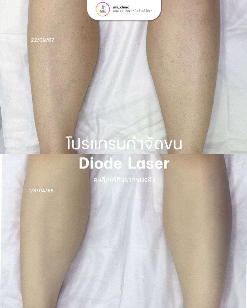 เลเซอร์กำจัดขน1