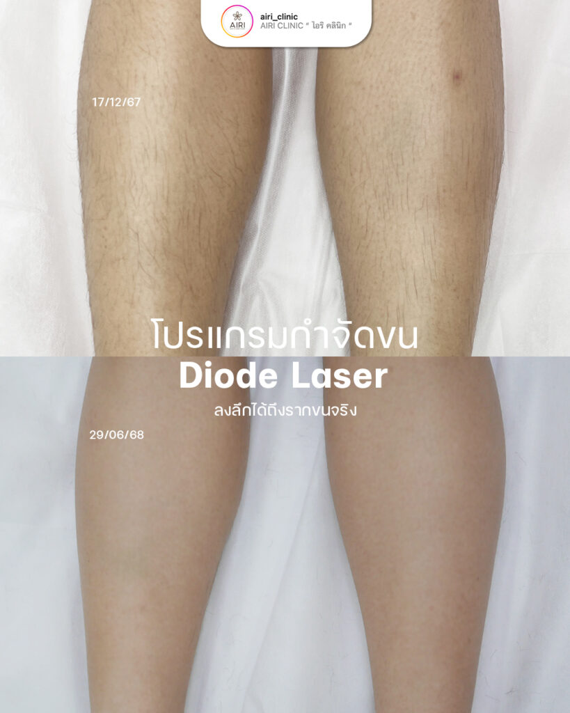 เลเซอร์กำจัดขน2