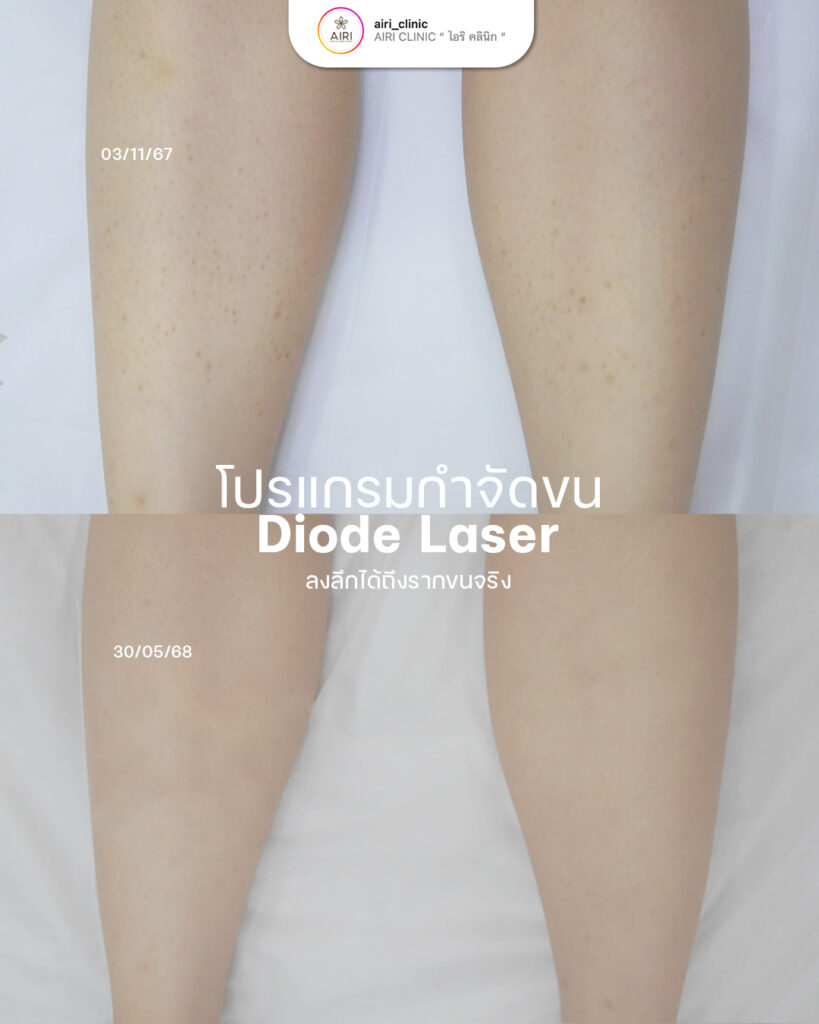 เลเซอร์กำจัดขน3